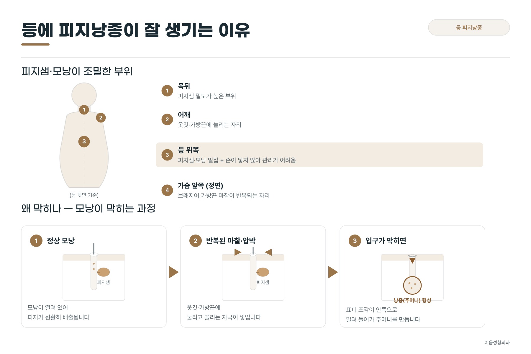 등에 피지낭종이 잘 생기는 이유