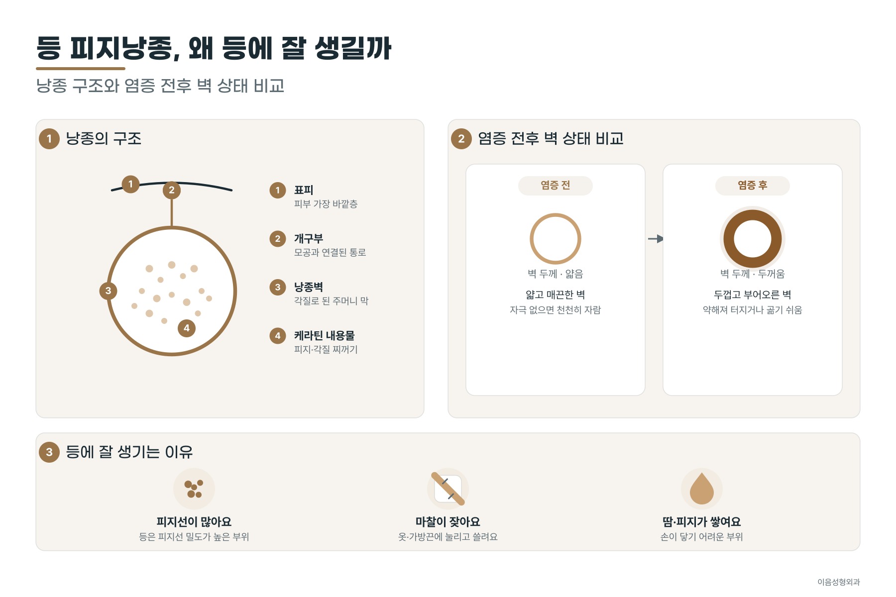 피지낭종의 구조와 염증 전후의 벽 상태 비교