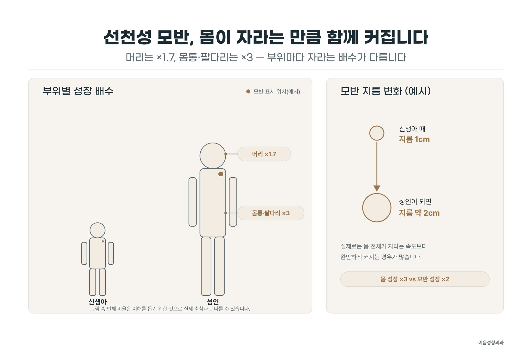 선천성 모반은 몸이 자라는 만큼 함께 커진다 — 부위별 성장 배수