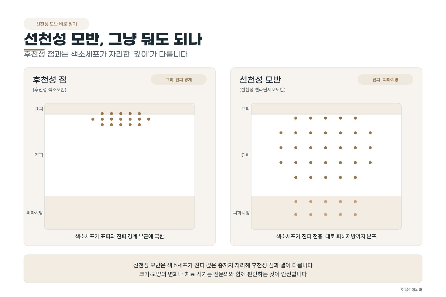 후천성 점과 선천성 모반의 색소세포 분포 깊이 차이를 나타낸 피부 단면 모식도
