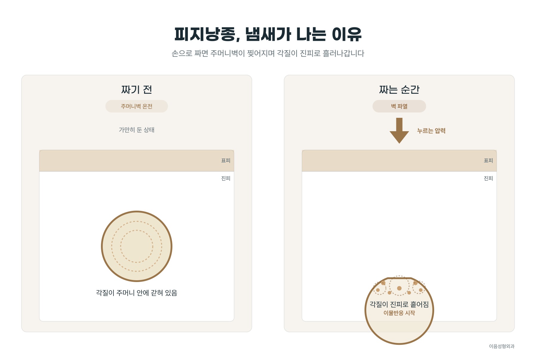 손으로 짤 때 주머니벽이 찢어지고 각질이 진피로 새어 나가는 모습