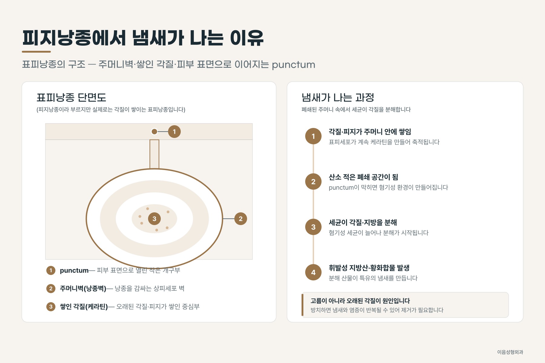 표피낭종의 구조 — 주머니벽, 쌓인 각질, 피부 표면으로 이어지는 punctum