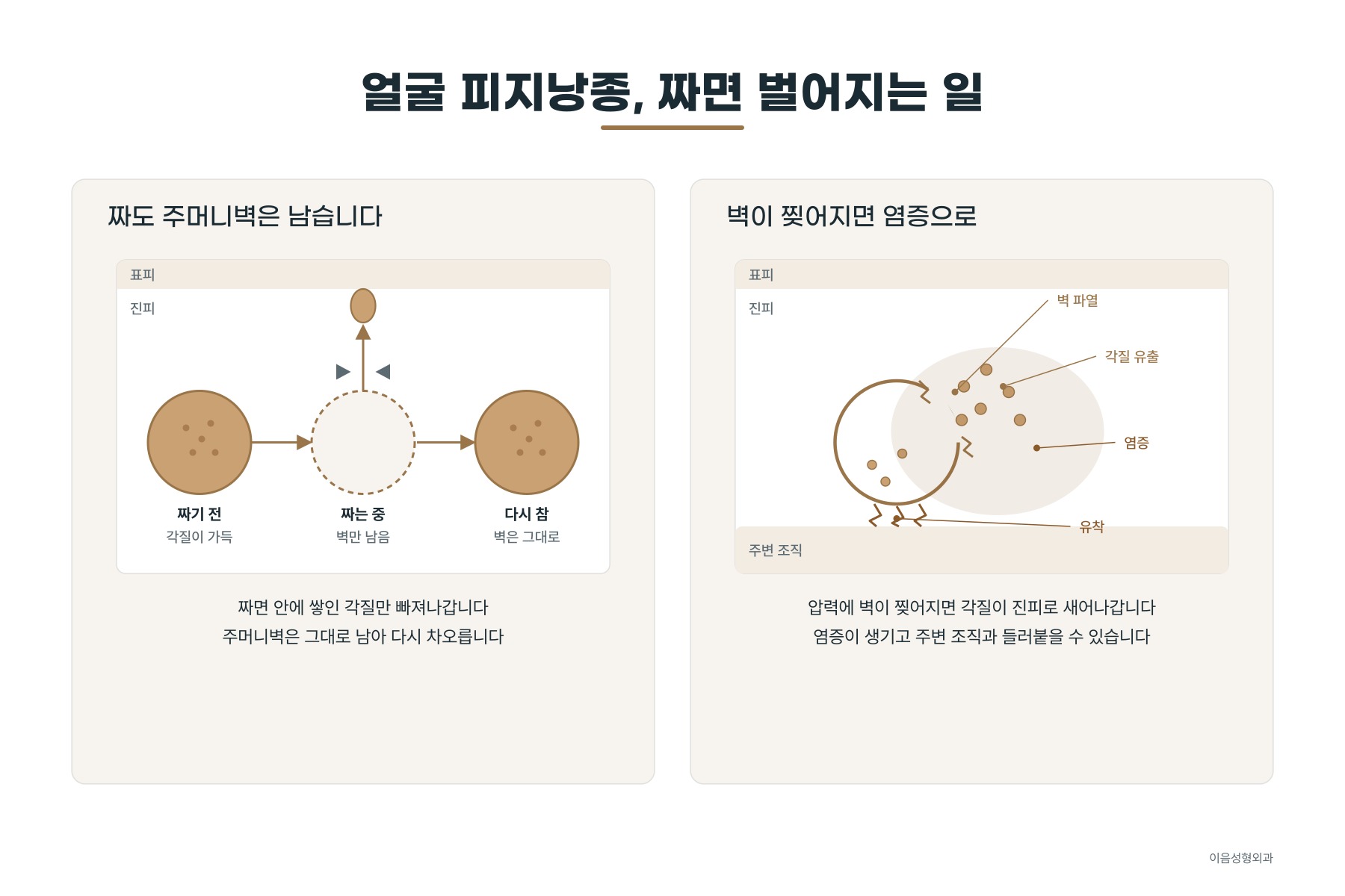 반복해서 짤 때 주머니벽이 찢어져 염증으로 이어지는 과정