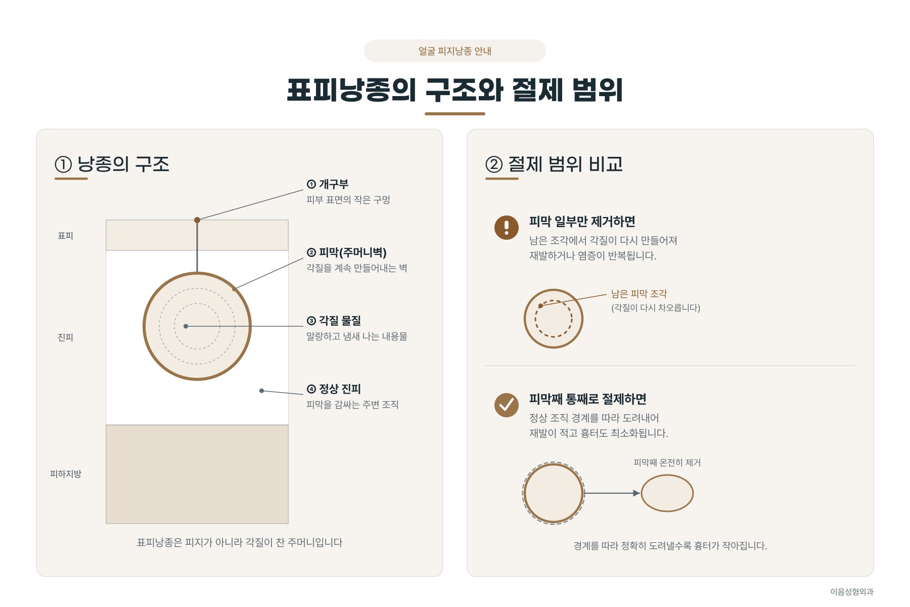 표피낭종의 구조와 주머니벽째 제거하는 절제 범위 모식도