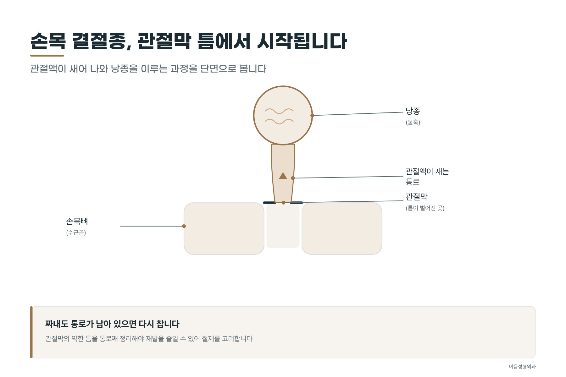 손목 관절막에서 관절액이 새어 나와 낭종을 이루는 결절종의 단면 모식도