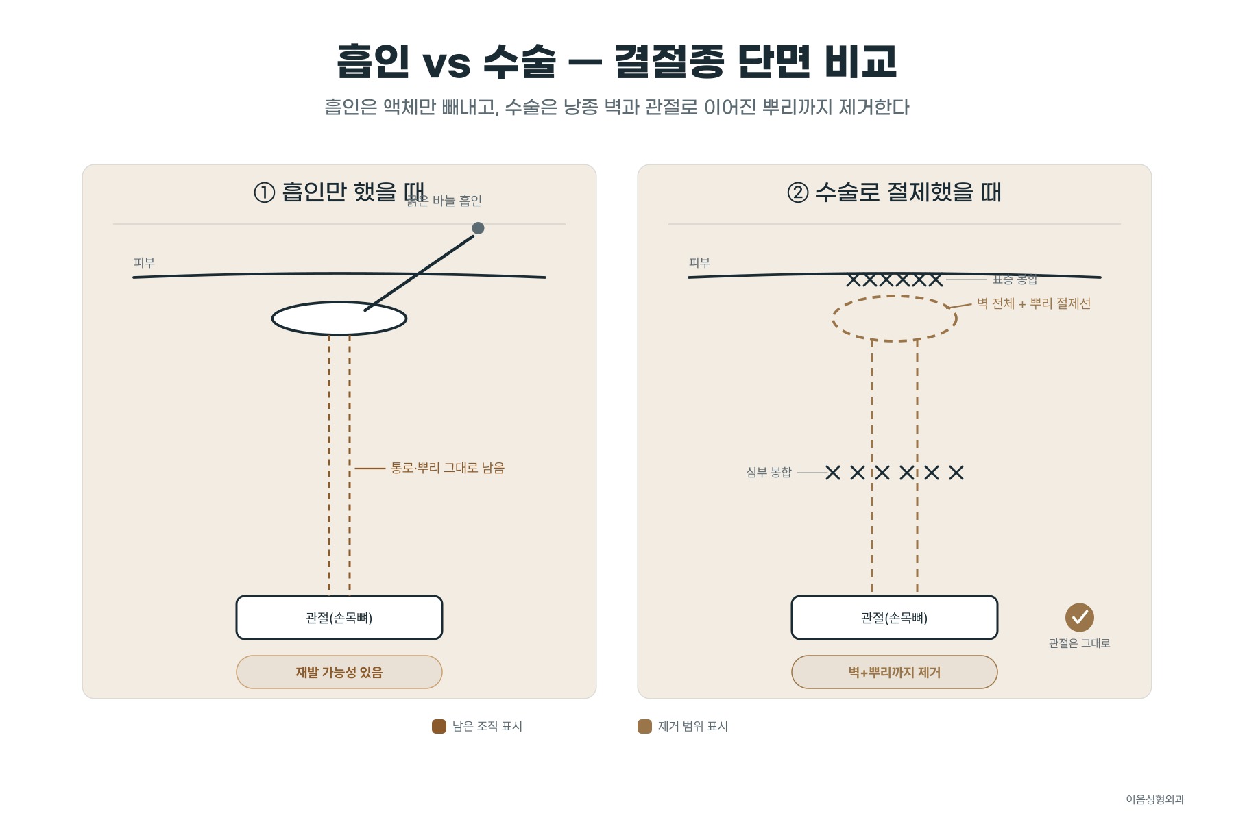 흡인은 액체만 빼내고, 수술은 낭종 벽과 관절로 이어진 뿌리까지 제거한다