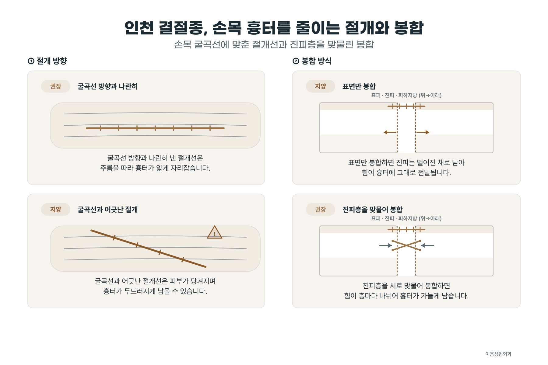 손목의 가로 굴곡선 방향에 맞춘 절개선과 진피층을 따로 맞물린 봉합