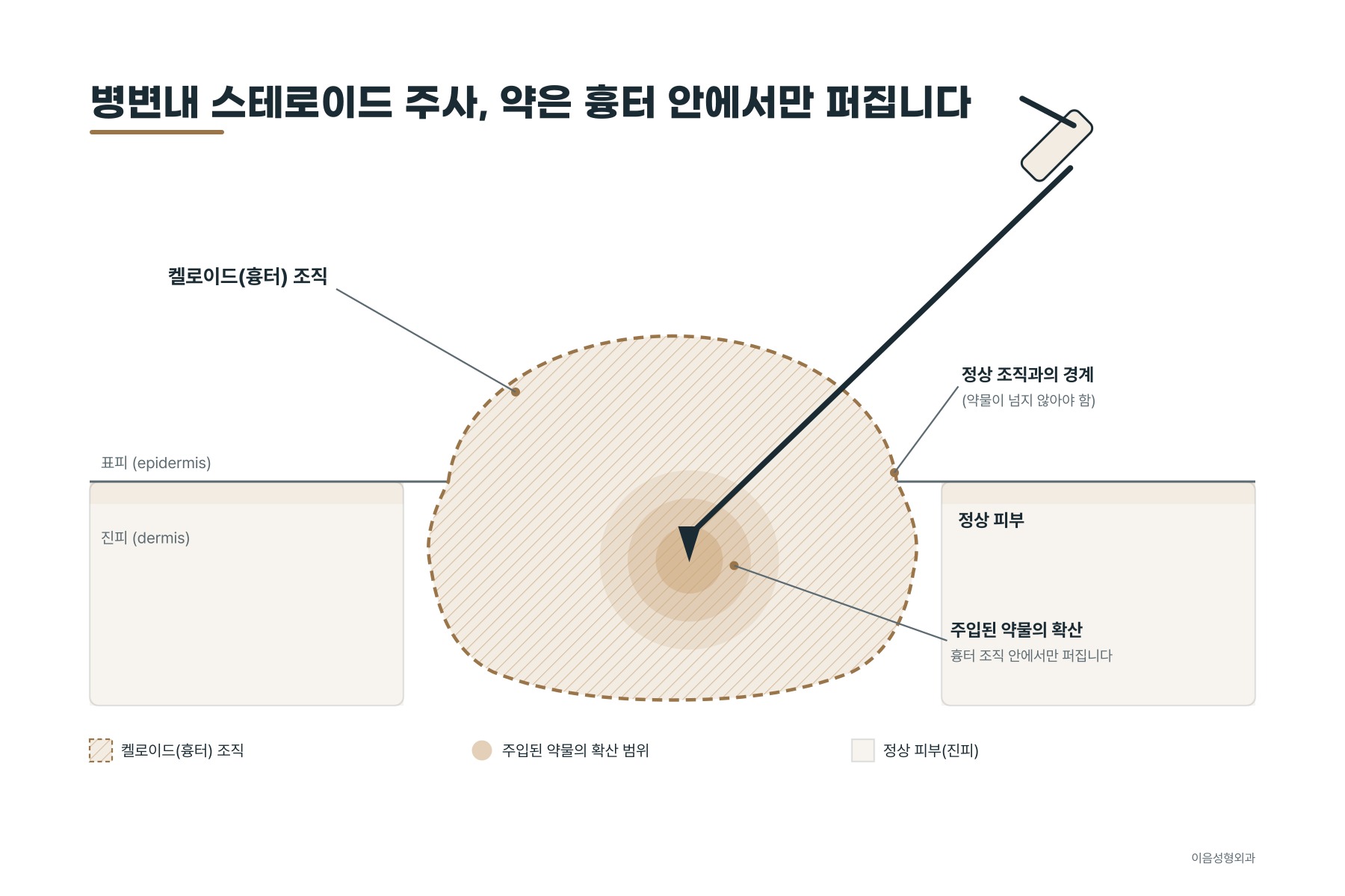흉터 조직 안쪽으로 스테로이드를 주입하는 병변내 주사 단면