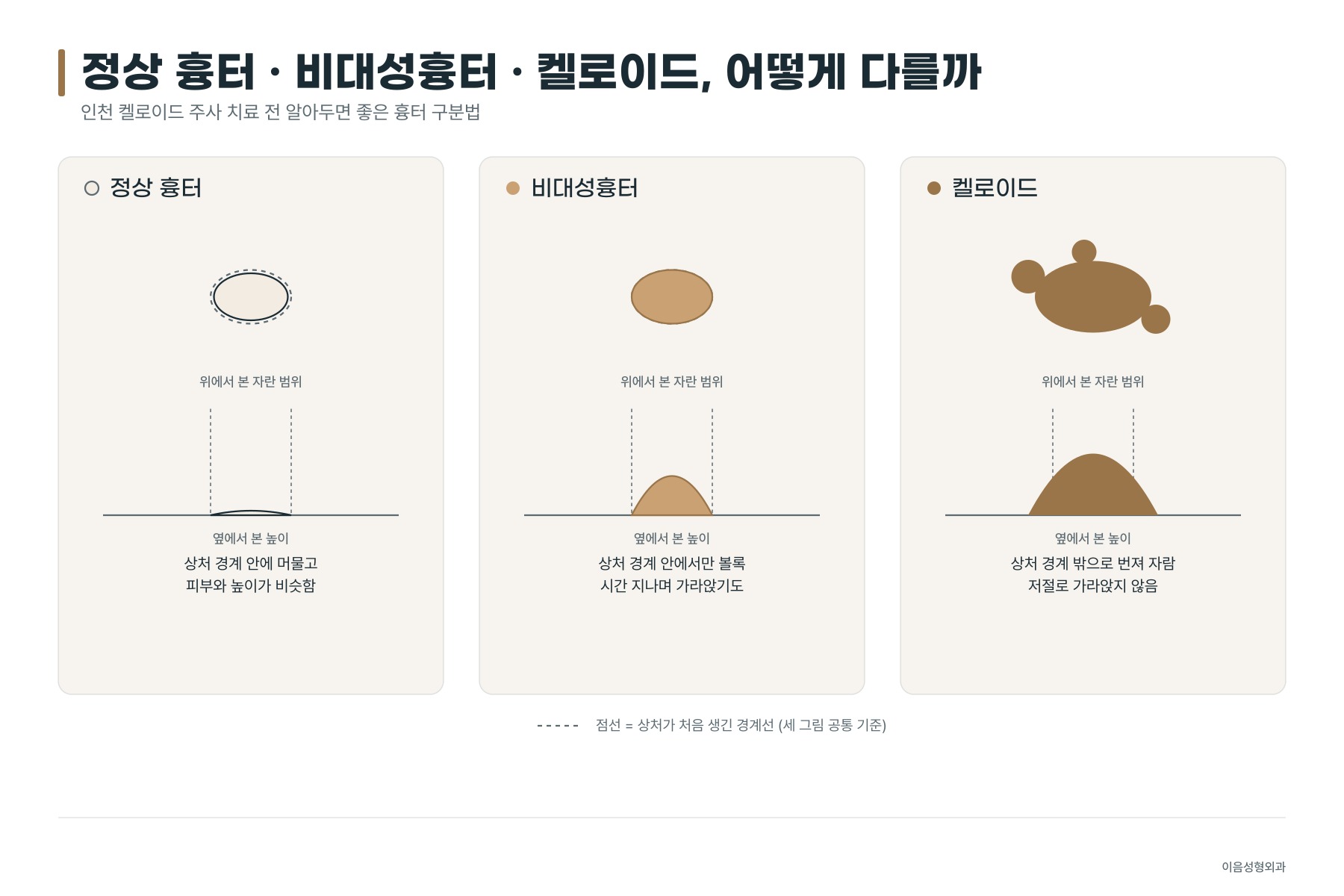 정상 흉터·비대성흉터·켈로이드의 성장 범위와 단면 높이 차이를 비교한 모식도