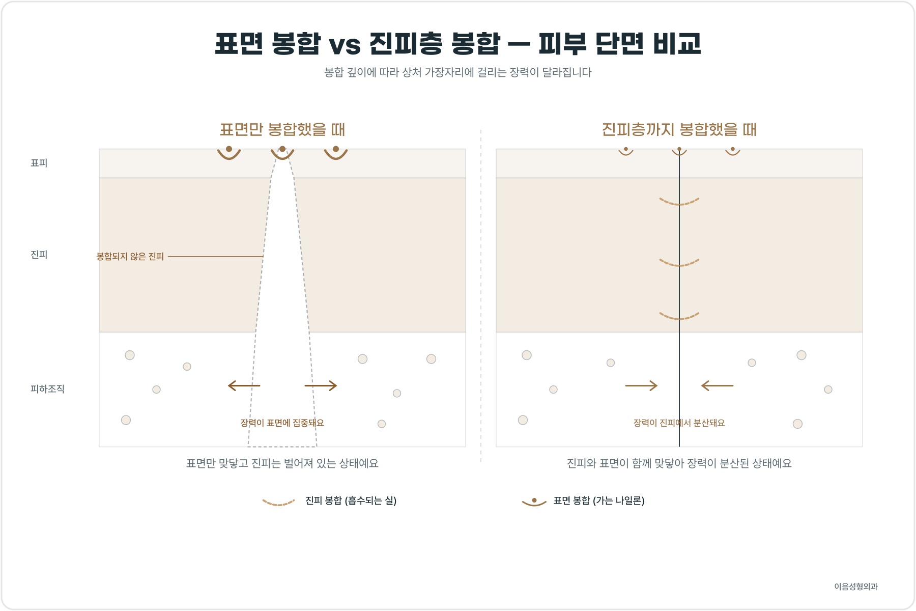 표면만 봉합한 경우와 진피층을 따로 봉합한 경우의 피부 단면 비교