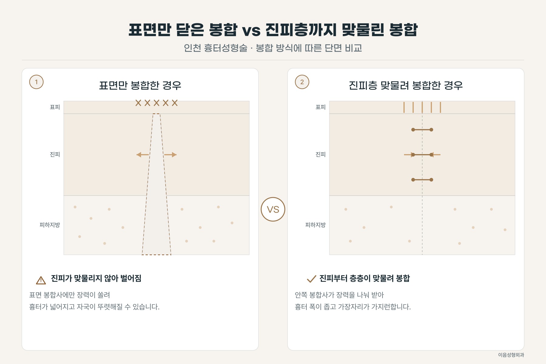 표면만 닫은 봉합과 진피층을 맞물려 닫은 봉합의 단면 비교