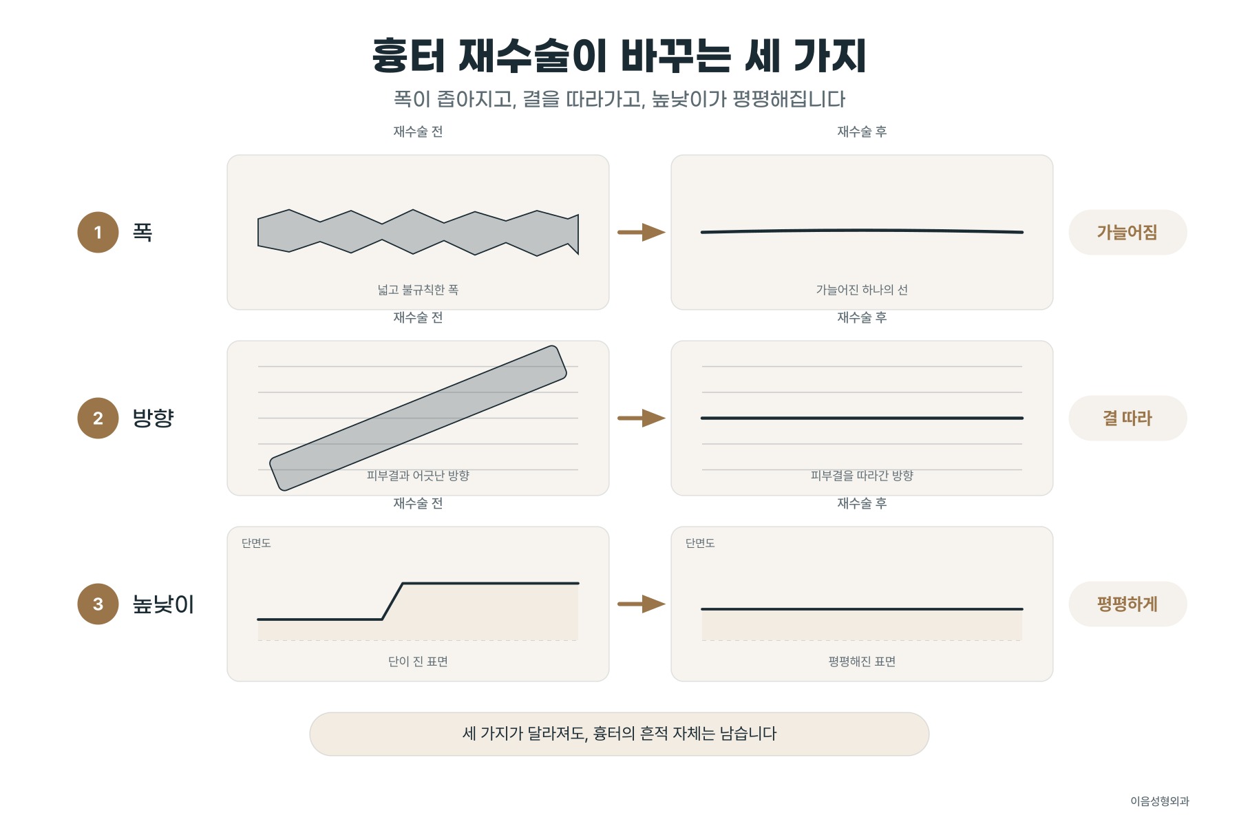 재수술이 바꾸는 것 — 폭, 방향, 높낮이. 바꾸지 못하는 것 — 흉터의 존재 자체