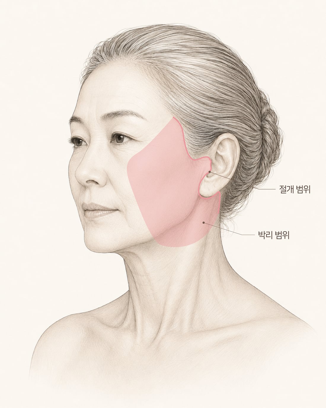 박리