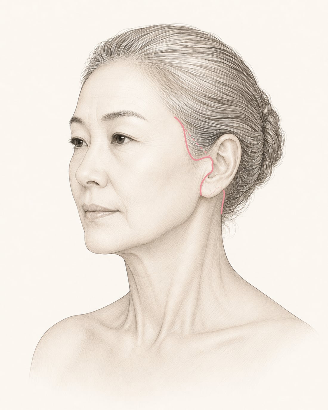 절개