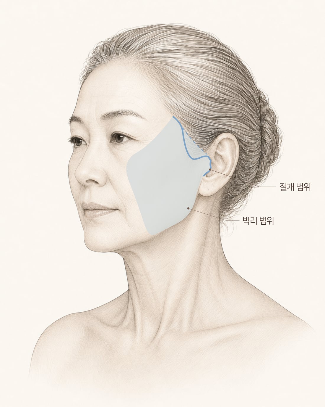 박리