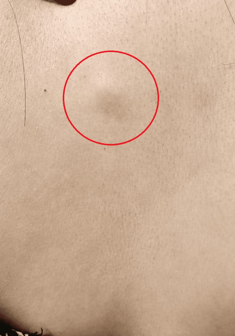피부 아래 만져지는 혹