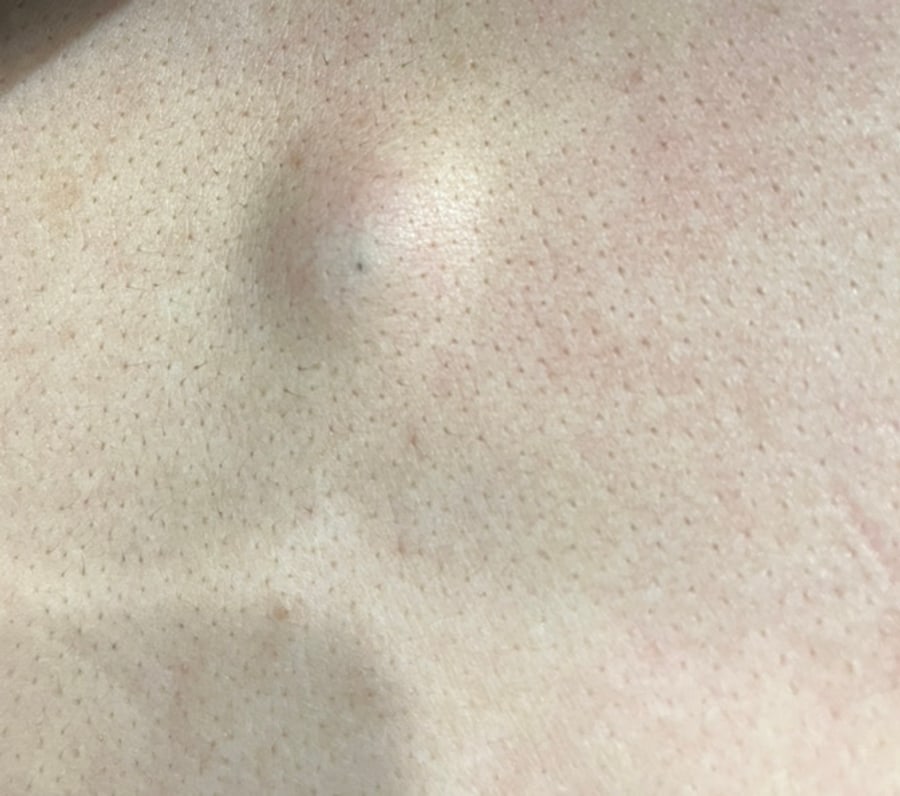표피낭종 — 피부 아래 만져지는 혹