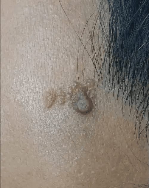 표피 모반