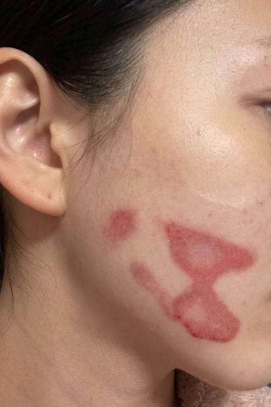 화상 후 남은 흉터