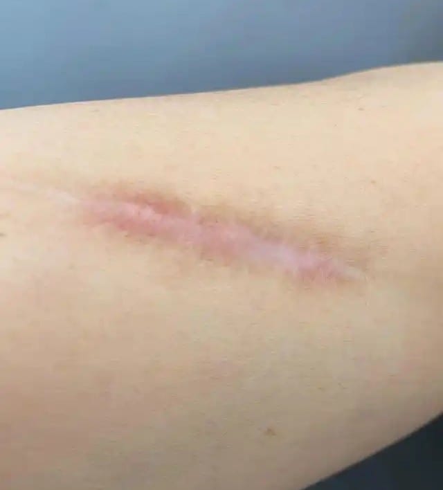 흉터가 변하는 시간
